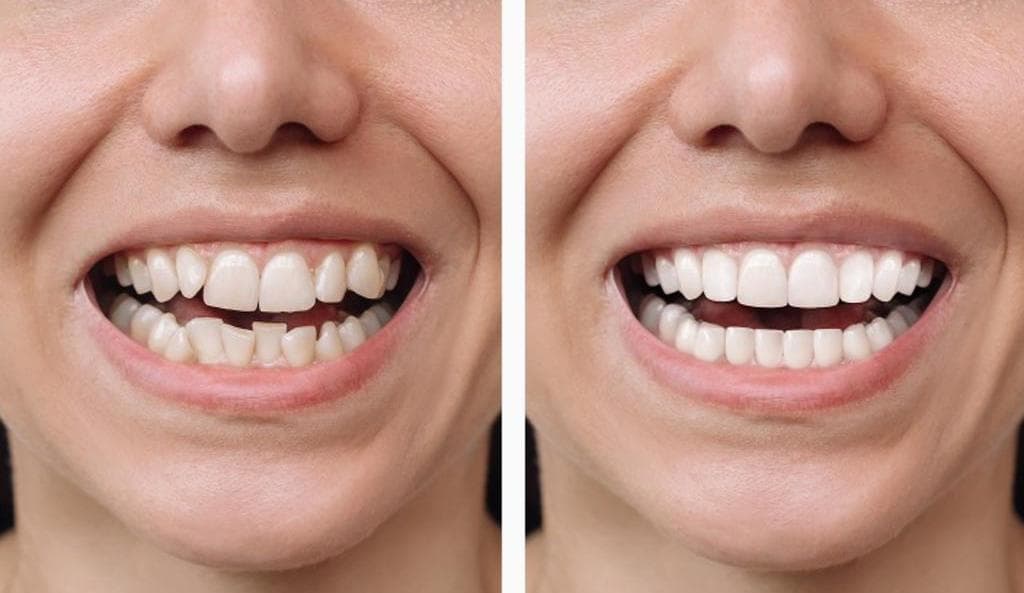 Veneers · Smile Symmetry — before and after result
